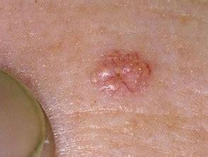 sebaceous hyperplasia dermnet